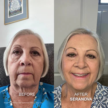 <strong>Lower Face Sagging</strong>