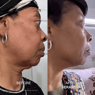 <strong>Neck Sagging</strong>